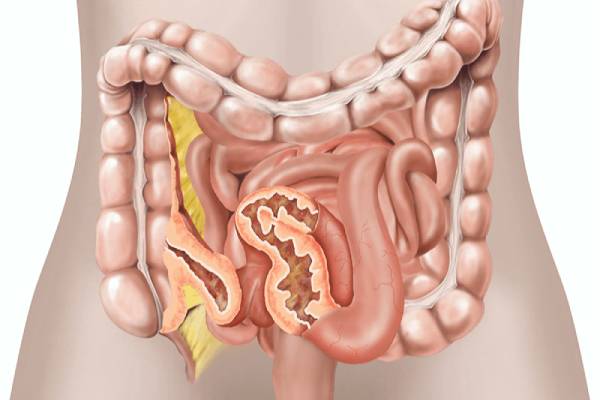 Crohn's Disease Treatment in Pune
