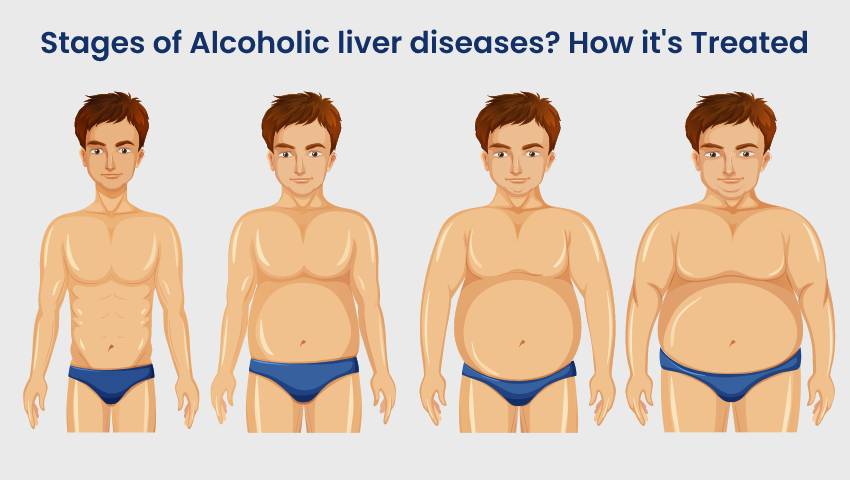 Alcoholic liver diseases