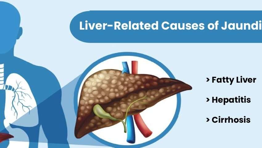 Liver-related causes of jaundice including fatty liver, hepatitis, and cirrhosis