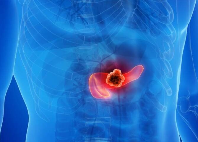 Educational image explaining how early detection of Pancreatic Cancer can save lives.