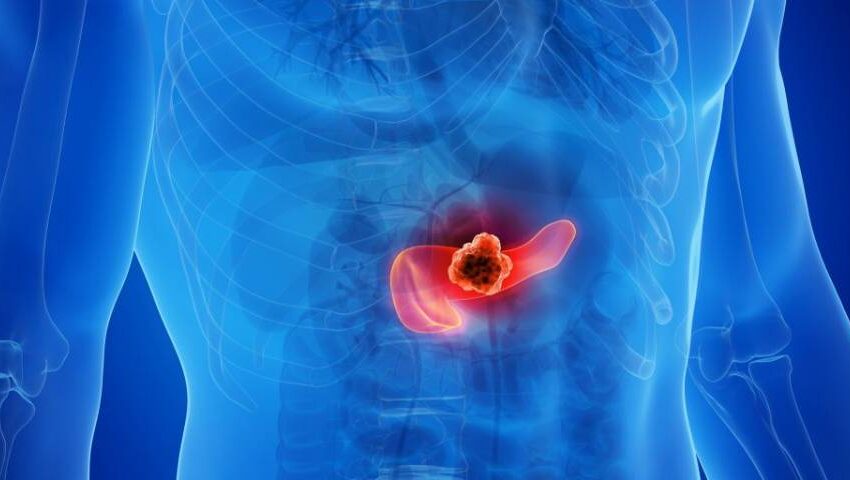 Educational image explaining how early detection of Pancreatic Cancer can save lives.