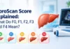 FibroScan score chart showing F0 to F4 liver fibrosis stages and liver stiffness levels